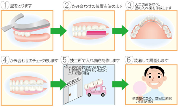 入れ歯治療手順