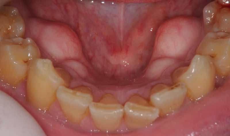 下顎骨隆起(舌側トーラス)