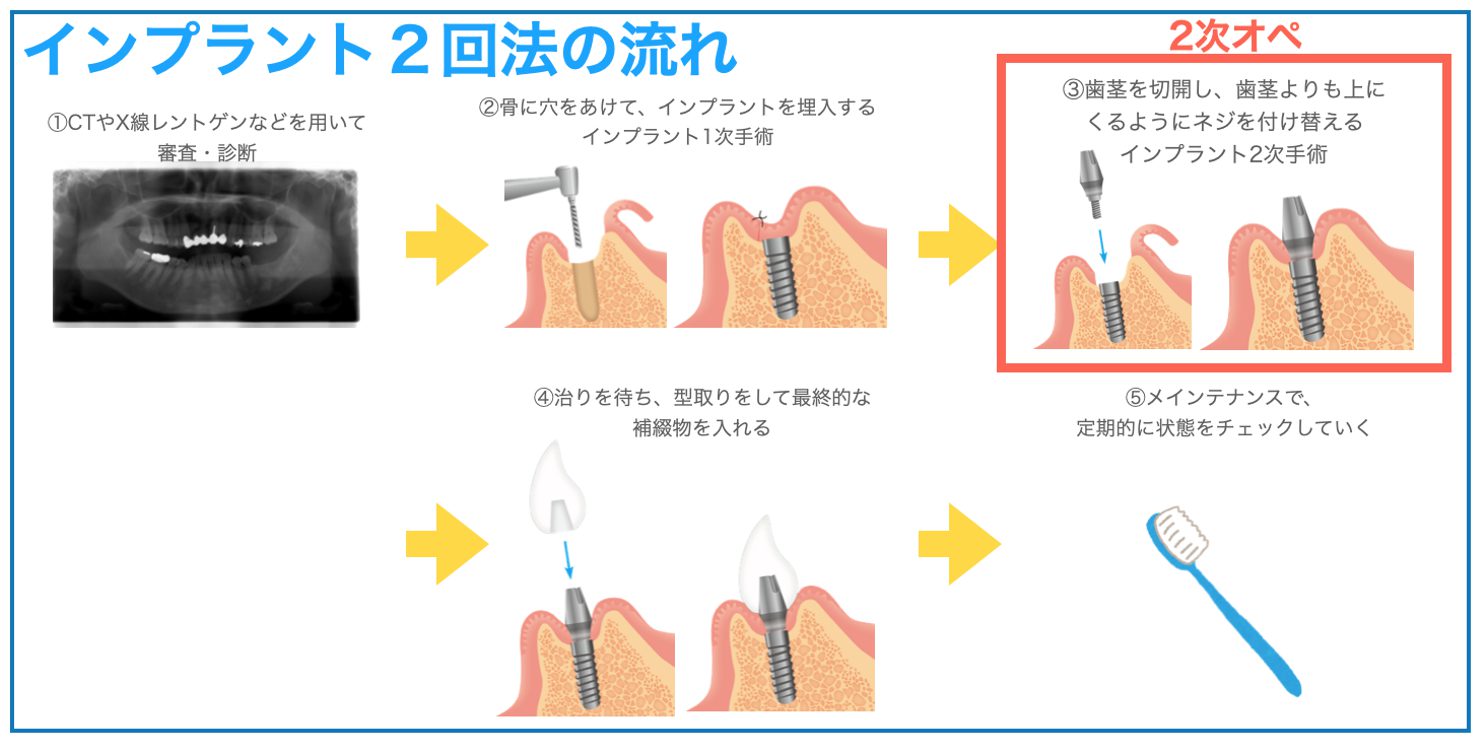 診断→埋入→治癒→上部構造→メンテナンスの手順イメージ