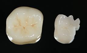 オールセラミッククラウン