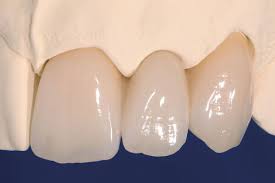 前歯の自費ブリッジ（術後）