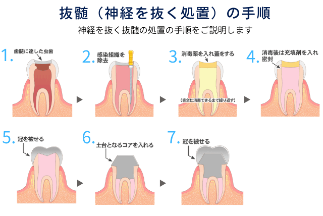 根管治療の工程イメージ（アクセス→清掃→充填→補綴）