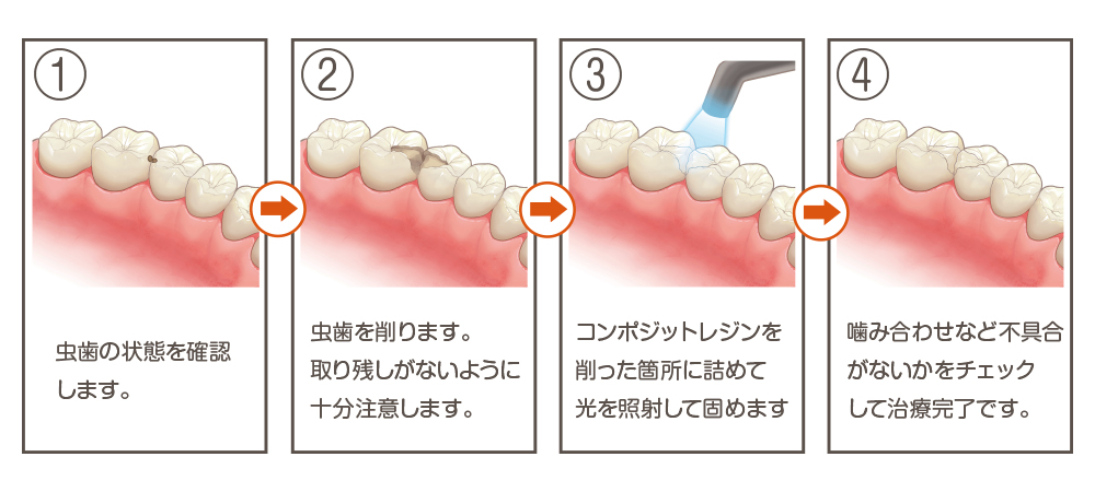 CR修復の手順イメージ