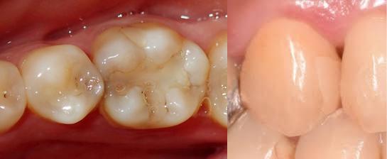 コンポジットレジン修復イメージ