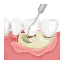 フラップ手術 手順イメージ