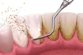器具によるスケーリングのイメージ
