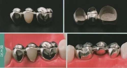 奥歯の保険ブリッジ（術後）
