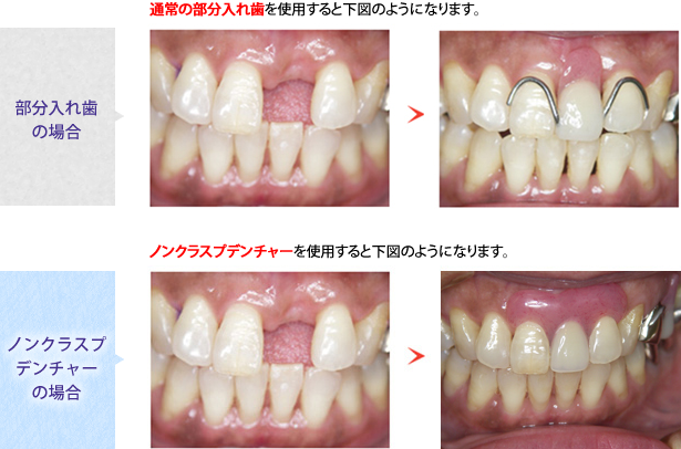 ノンクラスプ部分入れ歯 症例1