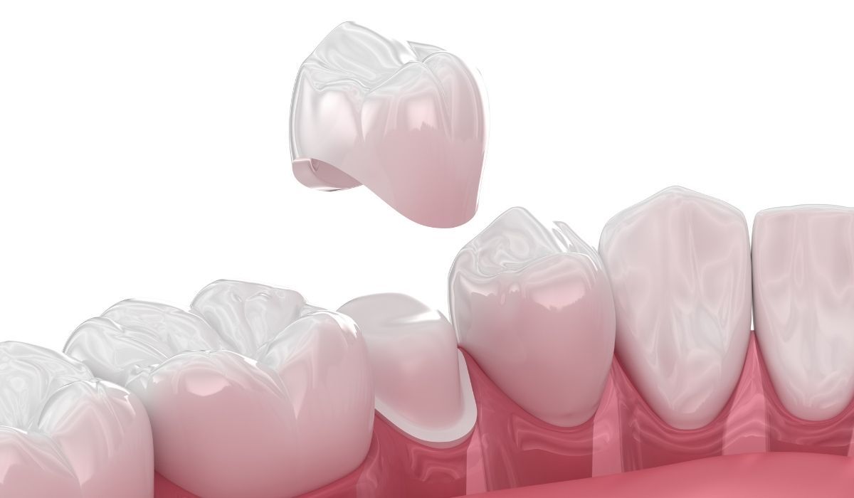 クラウン治療イメージ