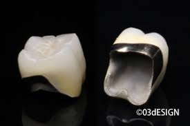 メタルボンドクラウン